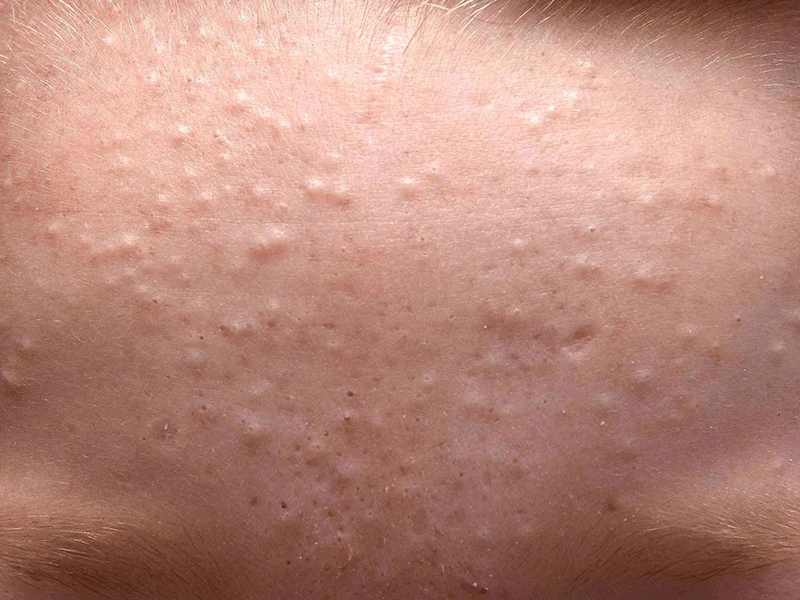 Trị mụn ẩn dưới da cần nhiều thời gian