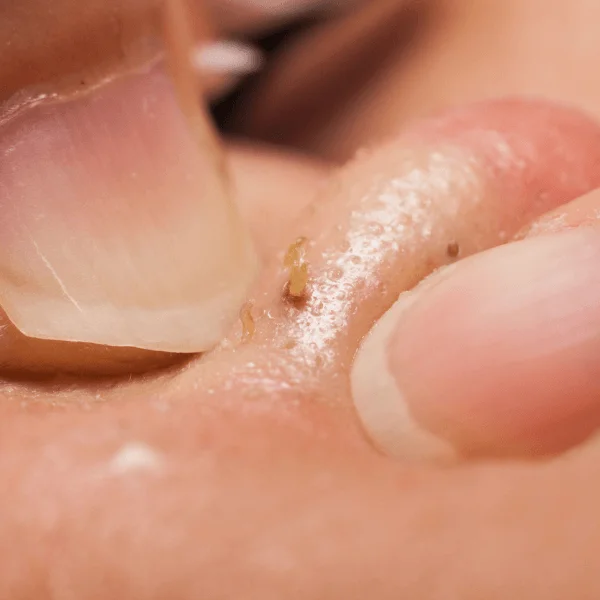 Cách trị mụn đầu đên không nên làm nhất là nặn mụn