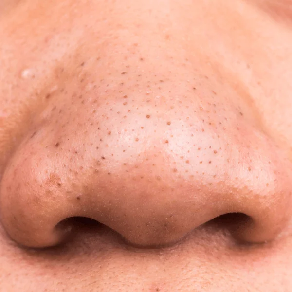 dau la cach tri mun dau den tot nhat 5