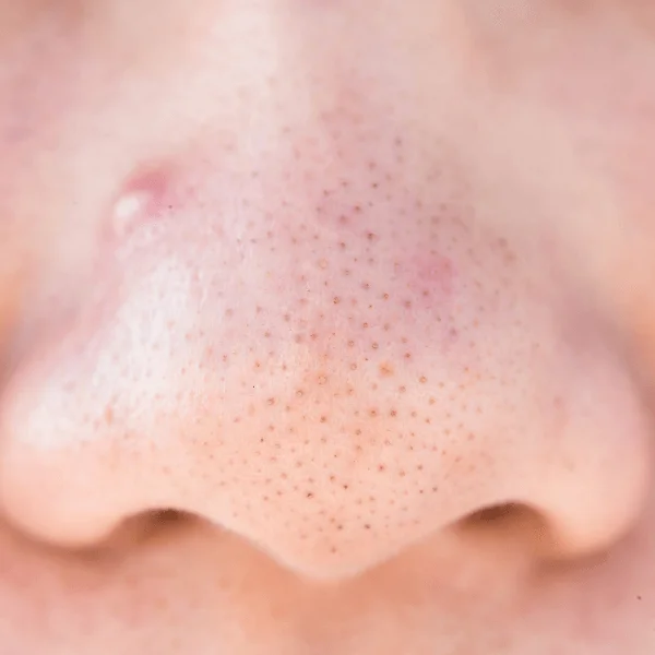 Cách trị mụn đầu đen