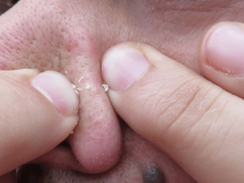 Resorcinol cải thiện mụn không viêm bằng cách loại bỏ bít tắc nang lông