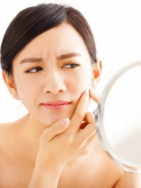 Mụn ẩn ở má khiến bạn ngại ngùng