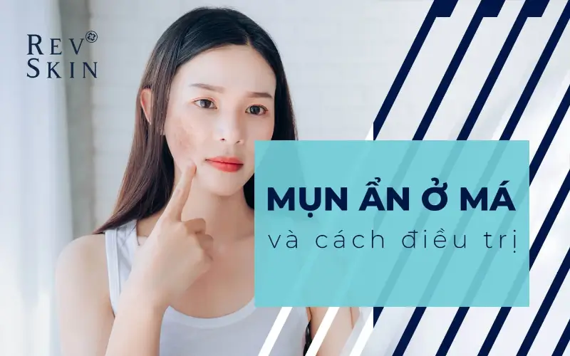 mun an o ma va cach dieu tri