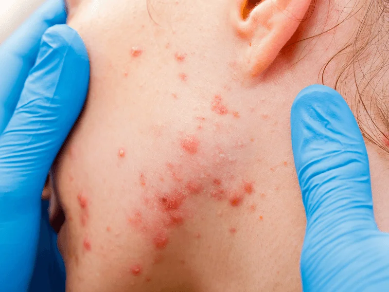 mun noi tiet nguyen nhan va cach dieu tri 2