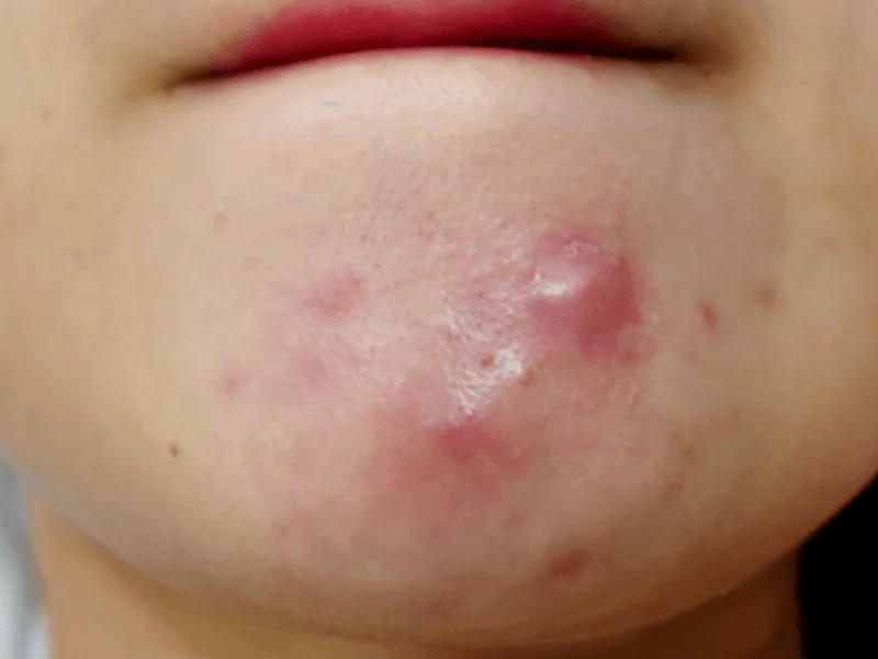 mun noi tiet nguyen nhan va cach dieu tri