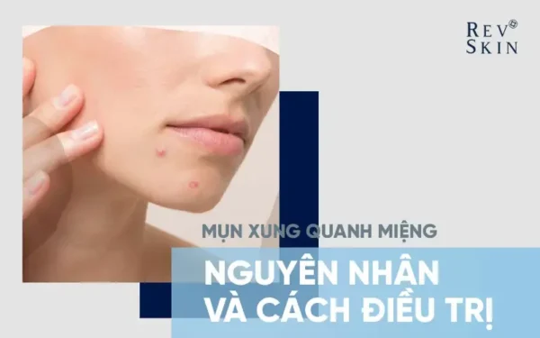 mun xung quanh mieng va cach dieu tri