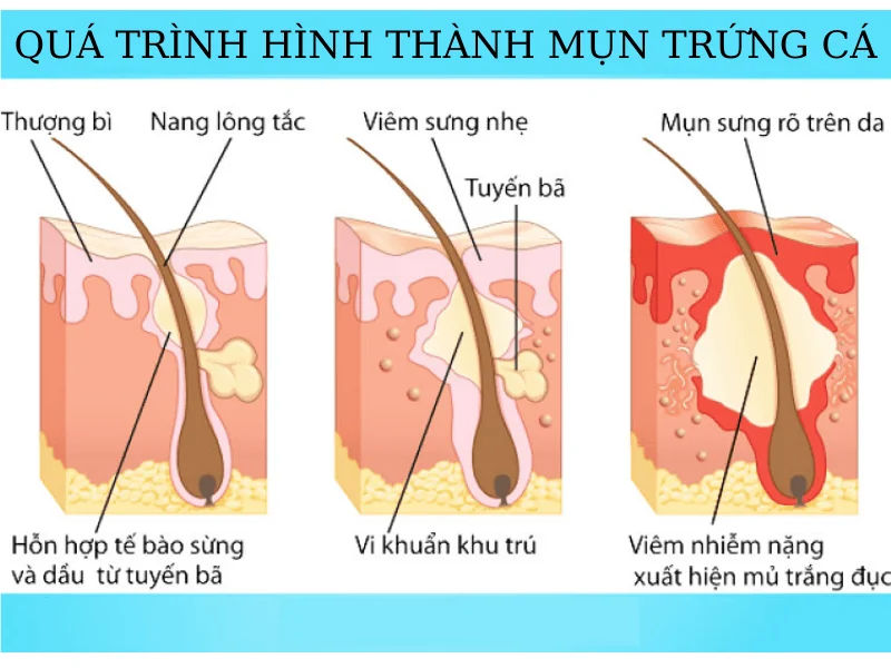 nguyen nhan va cach dieu tri mun day thi 3 2