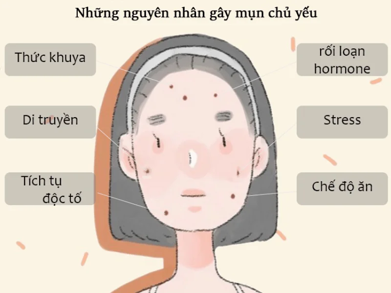 Những nguyên nhân gây nên mụn ẩn dưới da
