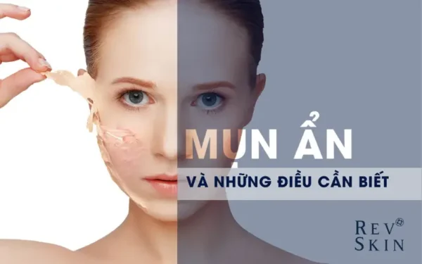 nhung dieu ban can biet ve mun an