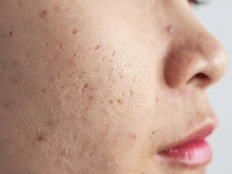  Nặn mụn ẩn có nguy cơ để lại sẹo rỗ khá cao 