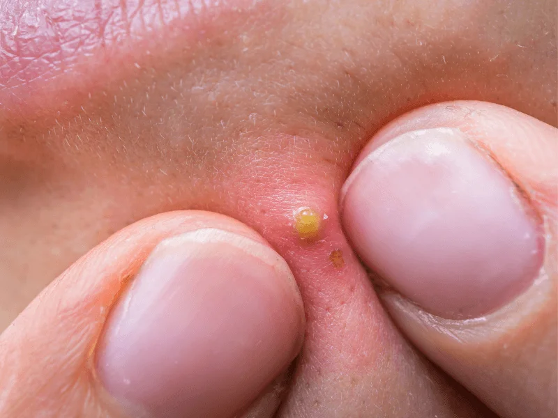 Vi khuẩn gây mụn thường phát triển trong nang lông chứ không phải trên bề mặt da