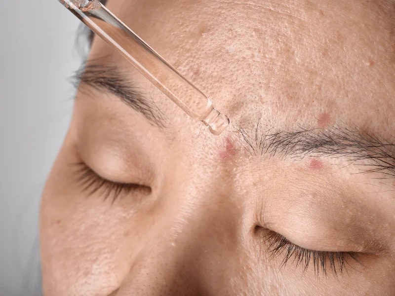 Không chỉ làm giảm viêm, vitamin C còn giúp ngăn ngừa sẹo mụn