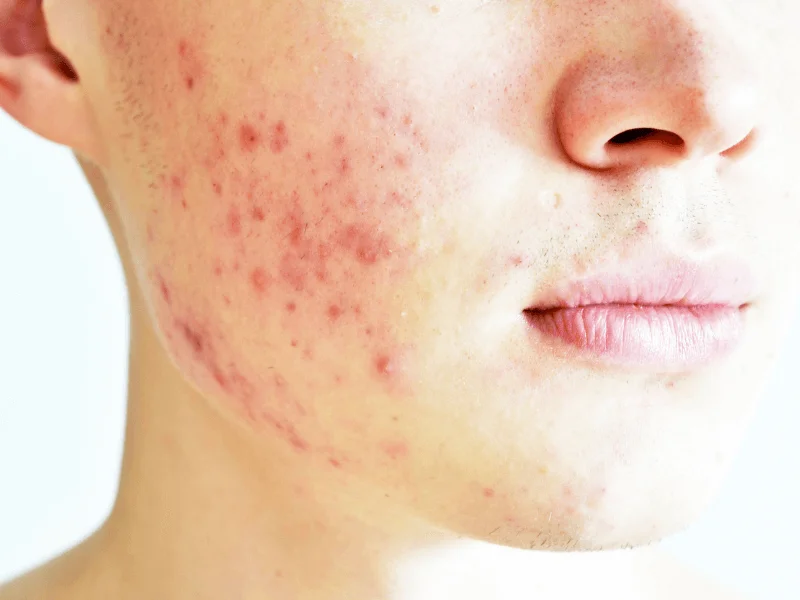 Không chỉ làm giảm viêm, vitamin C còn giúp ngăn ngừa sẹo mụn