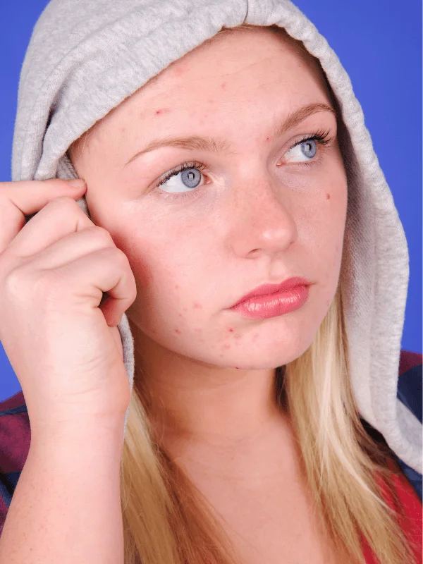 Da mụn ẩn khiến nhiều người tự tin và ngại giao tiếp