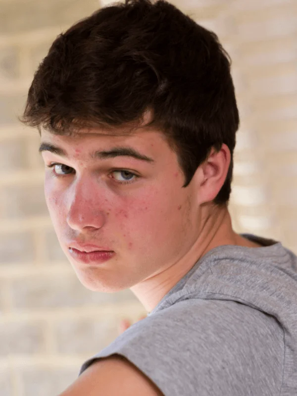 Mụn ẩn ở tuổi vị thành niên thường sẽ biến mất sau khi hormone trở lại bình thường