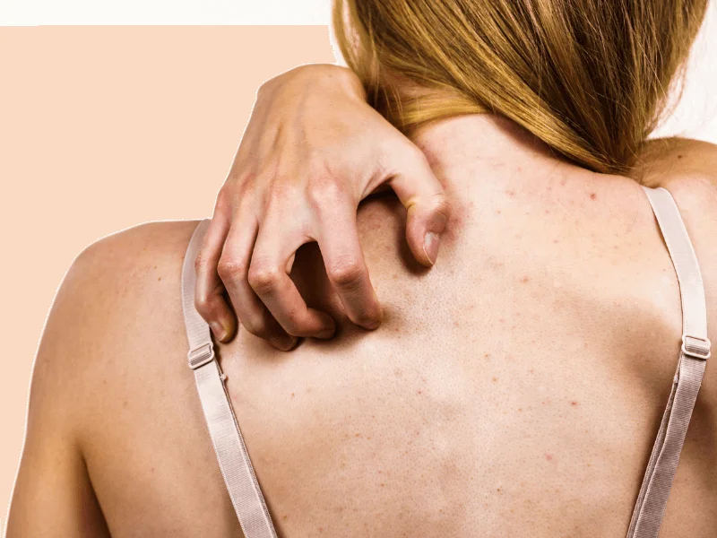 Dầu thừa, bụi bẩn và vi khuẩn là nguyên nhân chính gây mụn ẩn ở lưng