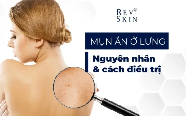 nguyen nhan va cach dieu tri mun an o lung