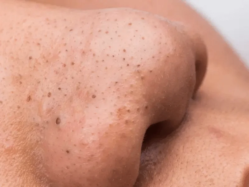 Nhân mụn đầu đen trồi ra bên ngoài bị oxy hoá dẫn đến bị đen ở đầu mụn