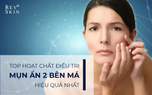 top hoat chat dieu tri mun an 2 ben ma