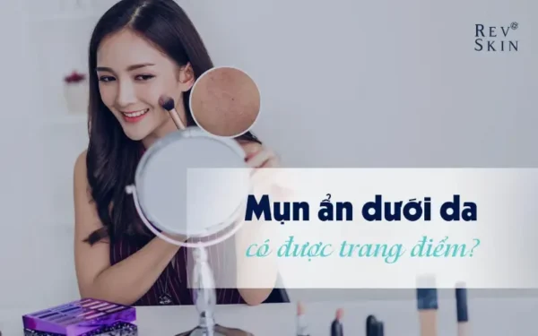 trang diem cho nguoi bi mun an duoi da