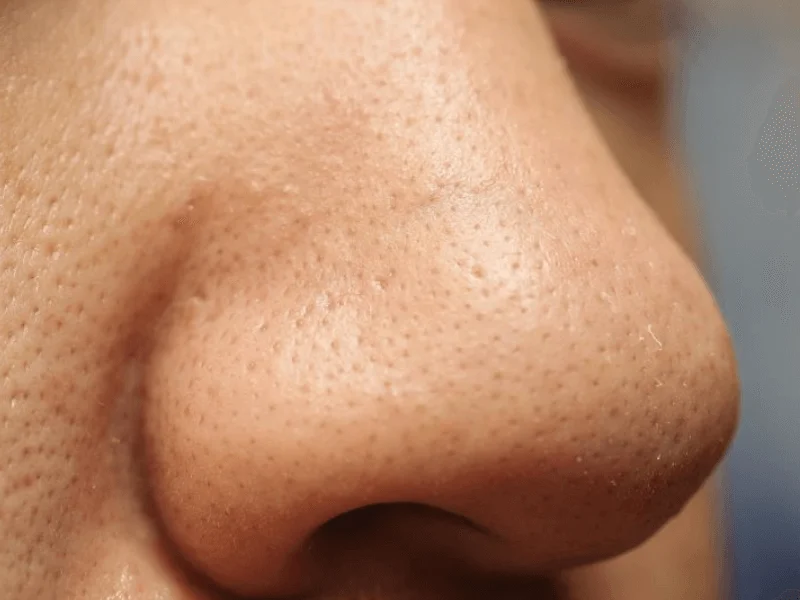 Mũi thuộc vùng chữ T nên tuyến dầu hoạt động mạnh mẽ và luôn có mụn