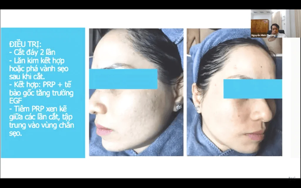 Phận loại từng loại mụn cùng với những phương pháp điều trị phù hợp