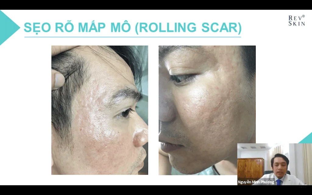 Phận loại từng loại mụn cùng với những phương pháp điều trị phù hợp