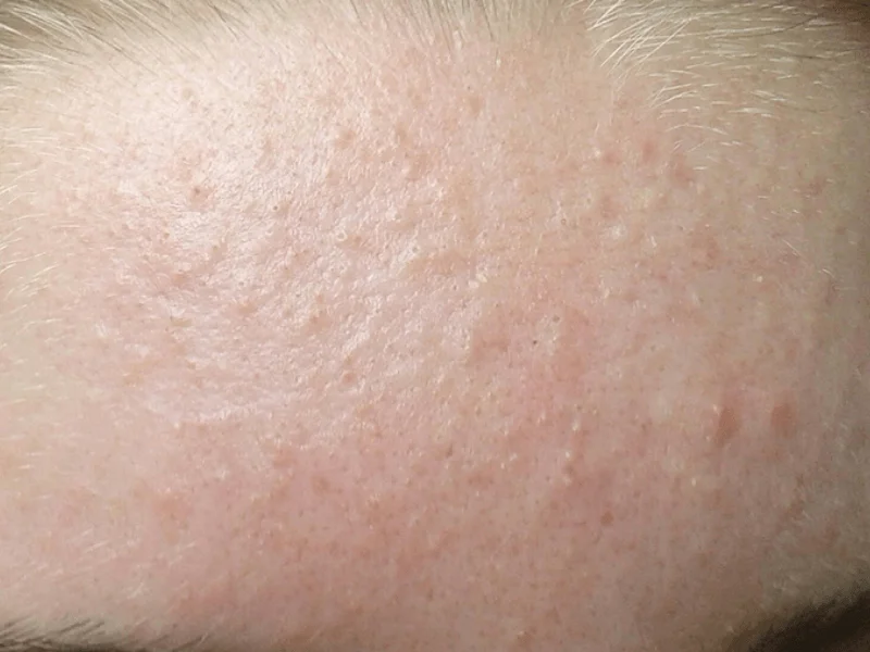 Trán thuộc vùng chữ T nên dễ rất có mụn