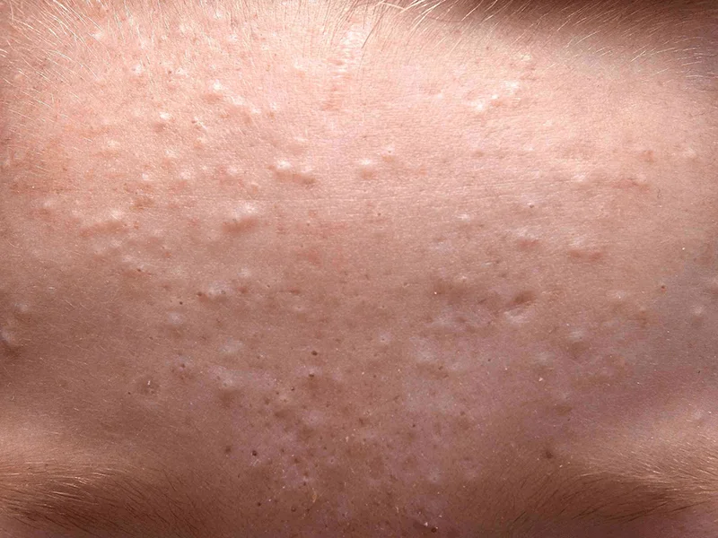 Những nốt sần dưới da là những nốt mụn ẩn