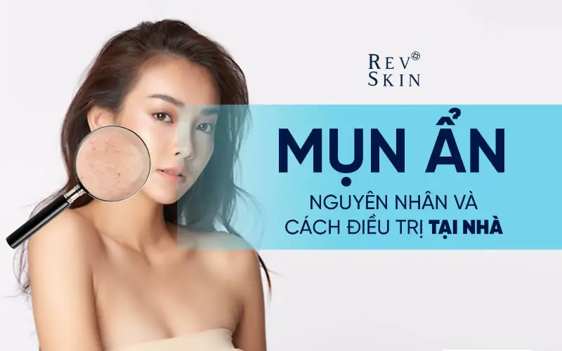 mun an va cach dieu tri