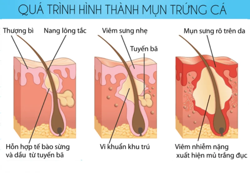 Quá trình hình thành mụn bên trong da giúp bạn biêt nên làm gì khi điều trị mụn tại nhà