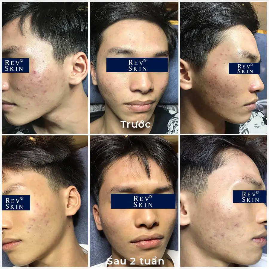 Kết quả sử dụng kem trị mụn RevSkin 