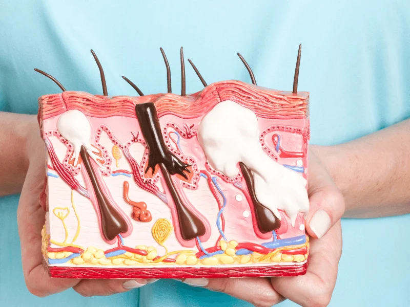 Hình ảnh mụn bên dưới da