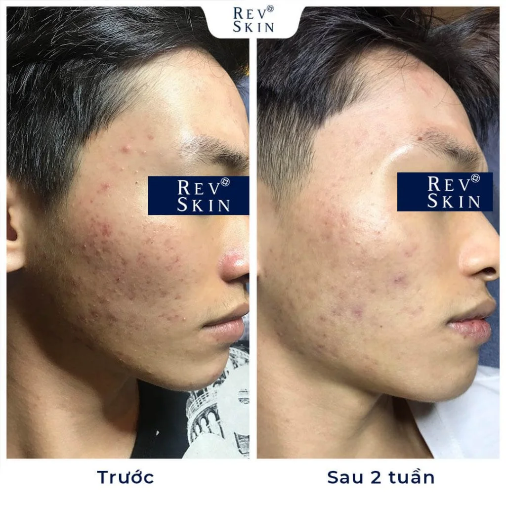 kem tri mun revskin acne cream co tot khong 4