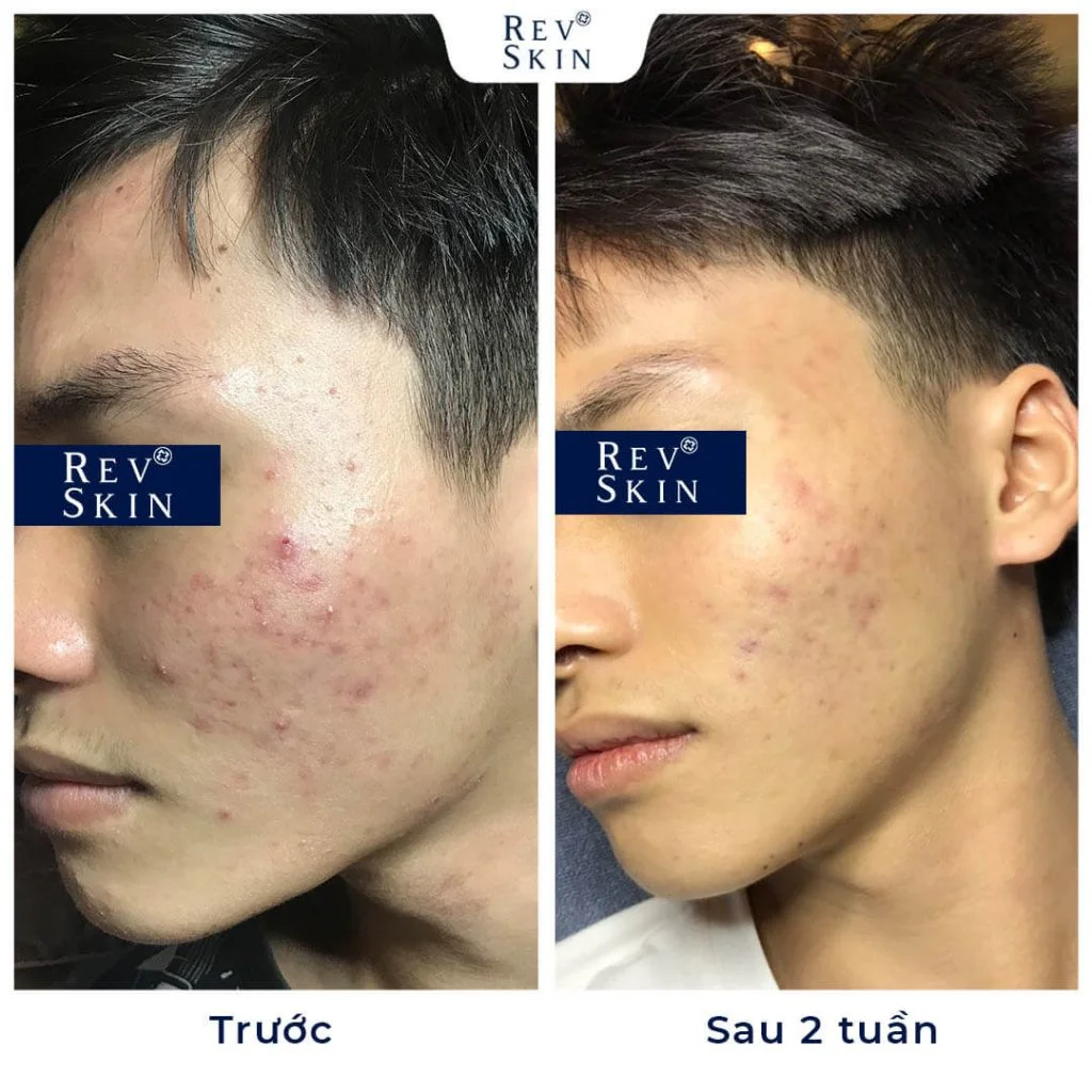 kem tri mun revskin acne cream co tot khong 5