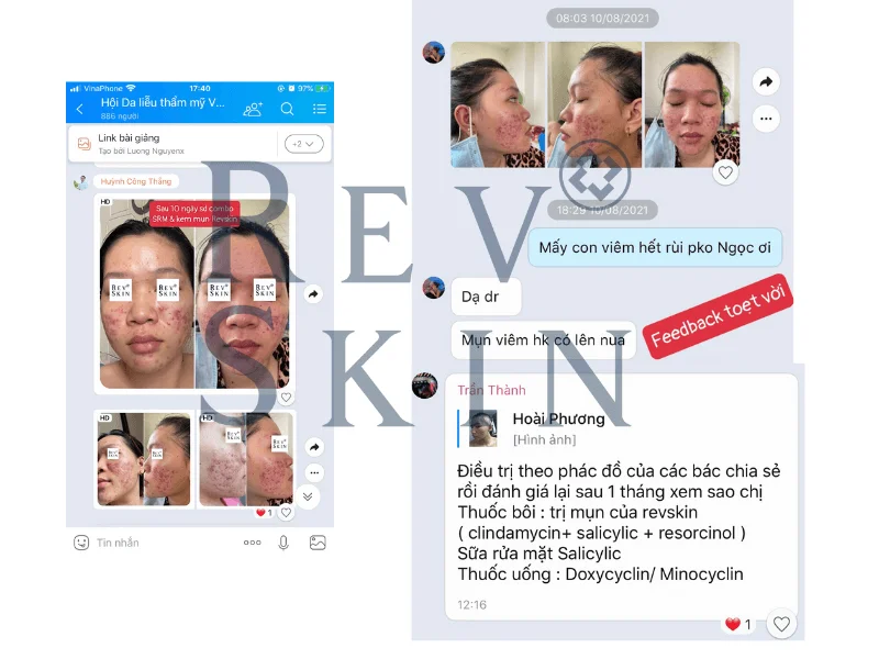 Review kem trị mụn RevSkin Ance Crean có thật sự hiệu  quả?