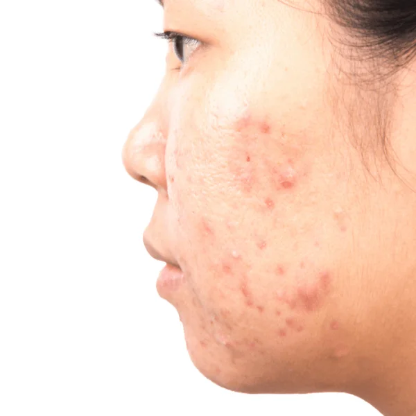 Kem chấm mụn RevSkin chuyên trị mụn viêm