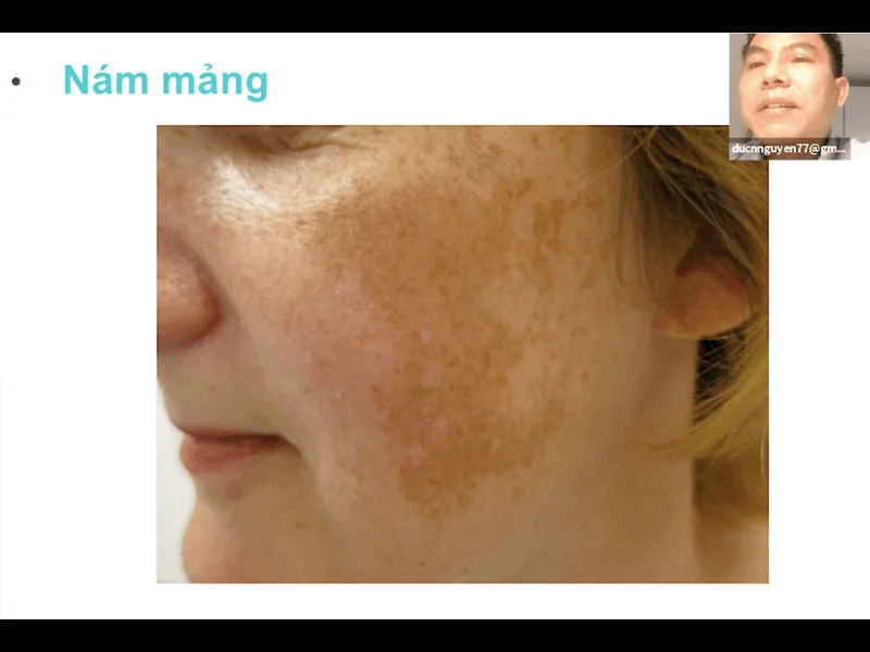 workshop chuyen sau ve nam laser tiem meso 1