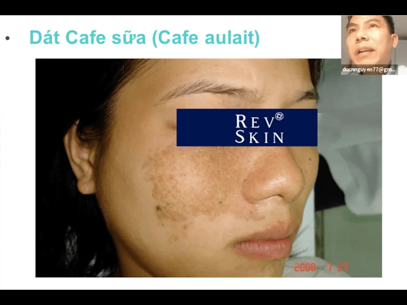 workshop chuyen sau ve nam laser tiem meso 2