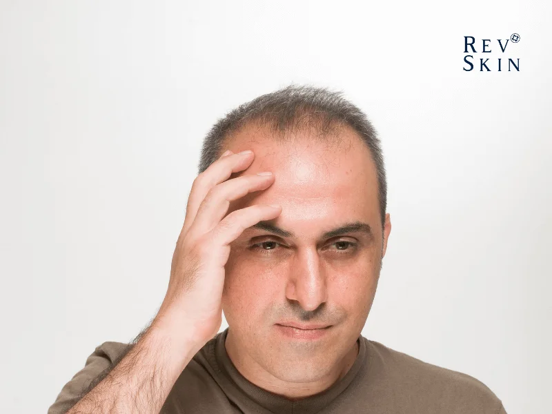 Nguyên nhân làm cho tóc mọc không dều