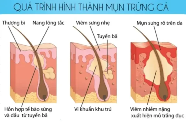 Quá trình hình thành mụn bên trong da