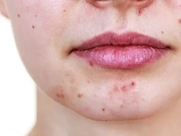 Nguyên nhân và cách điều trị mụn xung quanh miệng