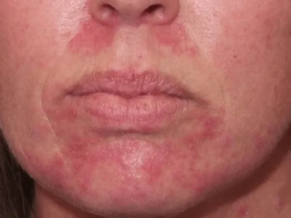 Viêm da gây đỏ quanh vùng miệng