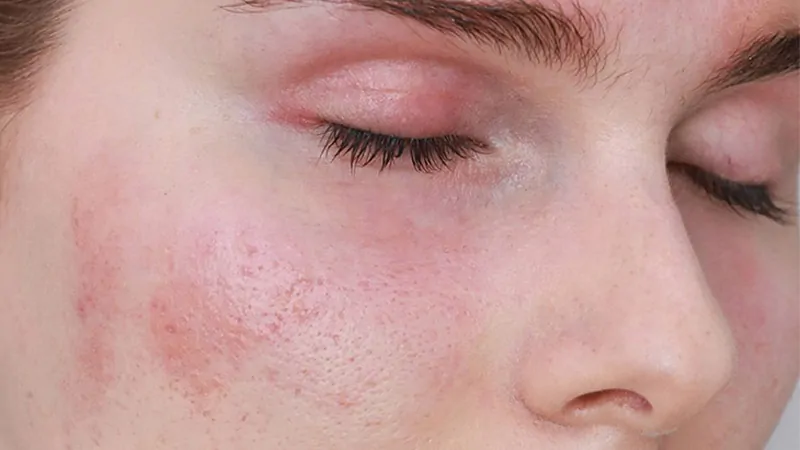 Làn da nhạy cảm cũng có thể peel da bằng những sản phẩm lành tính