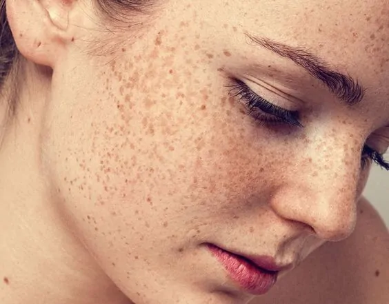 Tàn nhang là vấn đề thường gặp trên da