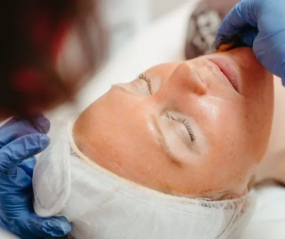 Peel da trị sẹo rỗ cũng là một phương pháp được ưa chuộng