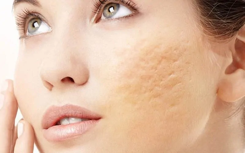 Sẹo rỗ gây mất thẩm mỹ và ảnh hưởng đến sự tự tin của nhiều người