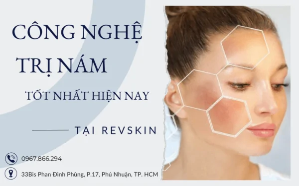 Công nghệ trị nám tốt nhất hiện nay