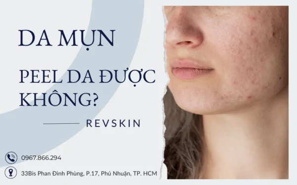 Da mụn có peel da được không