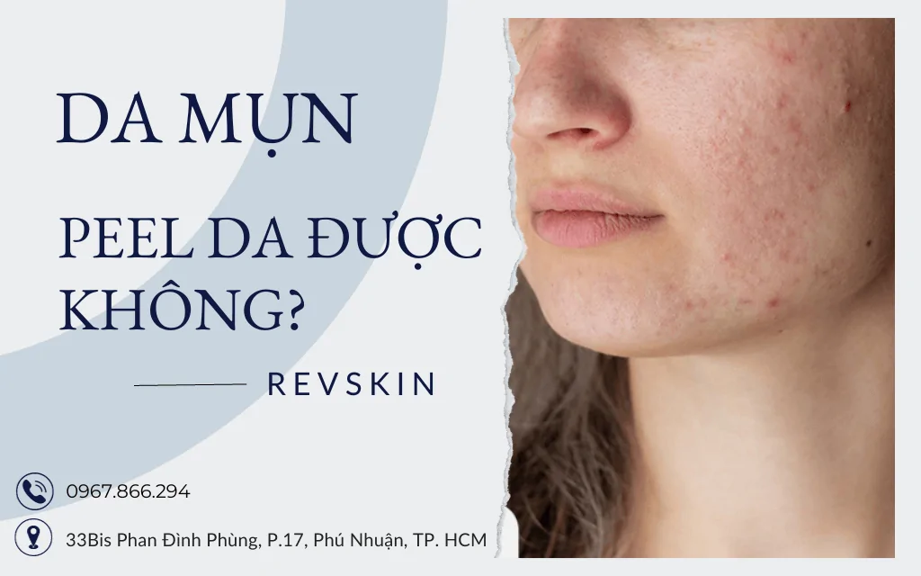 Da mụn có peel da được không